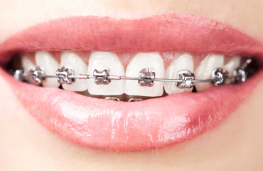 Braces & Aligners