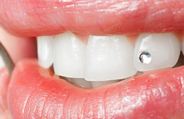 Dental Jewellery