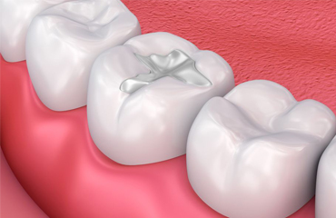 Dental Fillings