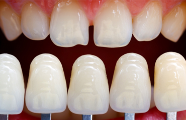 Dental Veneers